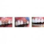 مایع اپکر کامپوزیت کازمادنت Cosmedent Creative Color Opaquers