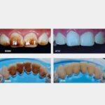 کیت پاک کننده stain دندانی | Antivet Kit