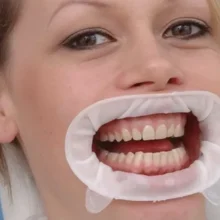 دهان‌بازکن OptraGate – دستگاه بازکن لب و گونه برای فرایندهای دندان‌پزشکی